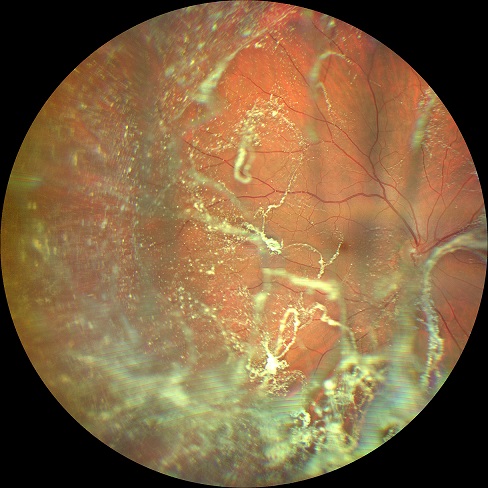 Vitreopatia Asteroide Bilaterale